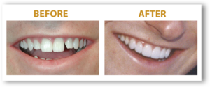 Man's chipped teeth Smile before and after
