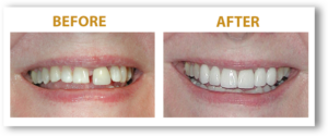 Womans tooth gap Smile before and after