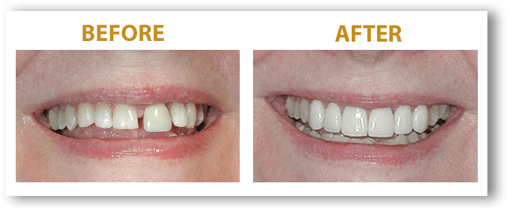 Womans tooth gap Smile before and after