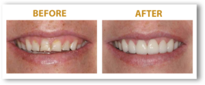 woman's misshapen teeth Smile before and after