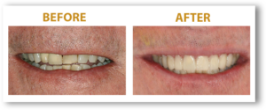 men's crooked teeth Smile before and after
