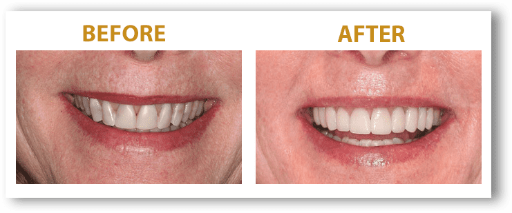 Woman's Smile before and after