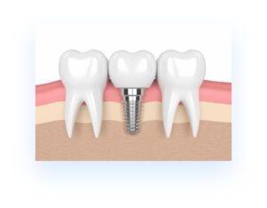illustration showing 3 teeth in gum layer with one dental implant