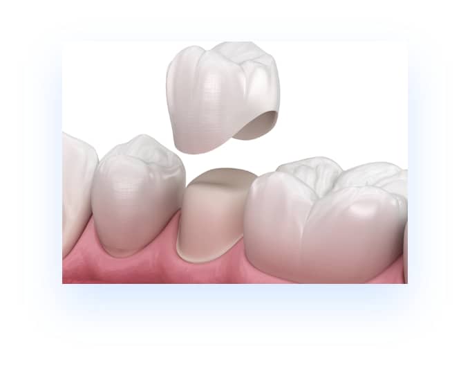 illustration of restorative dentistry crown being placed on natural tooth