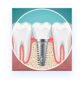 illustration of 1 dental implant surrounded by 2 regular teeth in gums